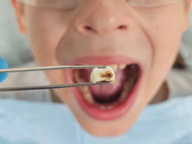 Best Urgent Care for Lost Fillings or Crowns in Bedford, IN