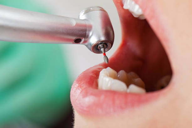 Best Emergency Tooth Extraction in Bedford, IN